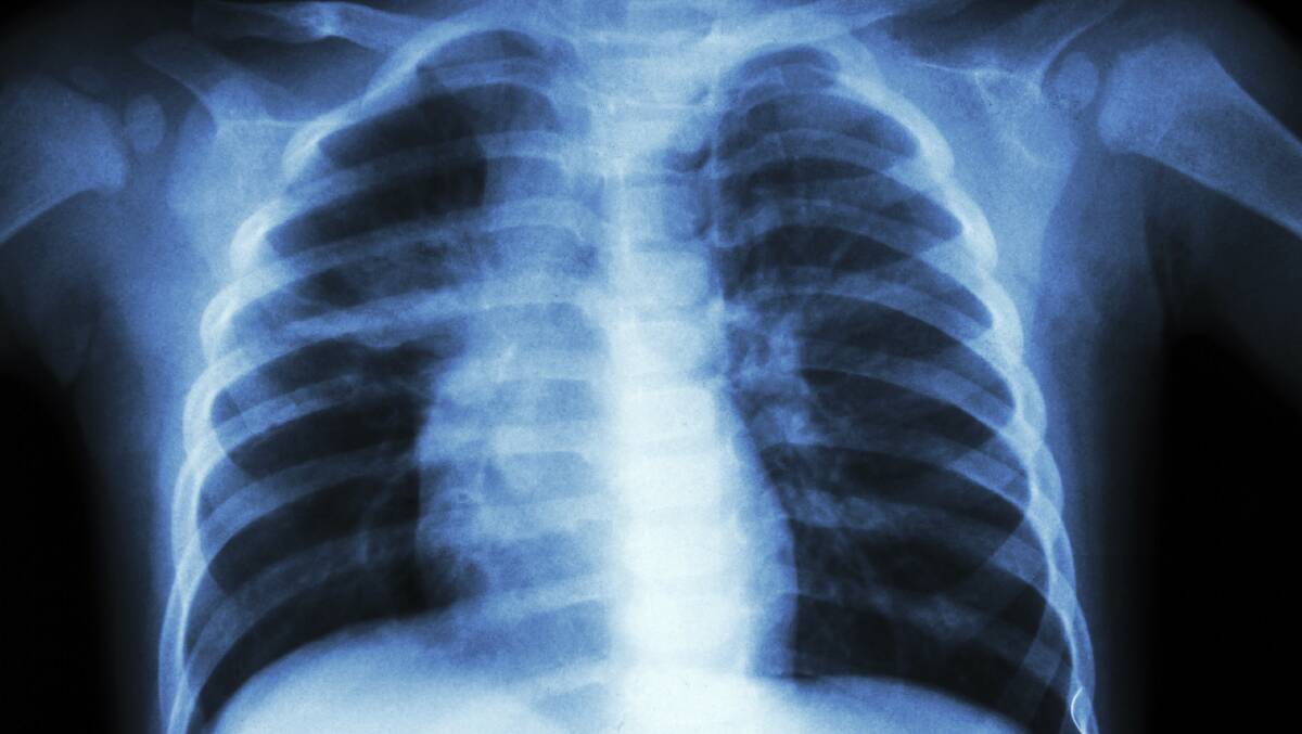 Lung seminar to help Mandurah patients breathe easier