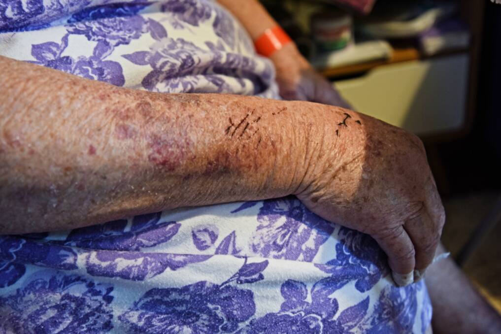 Sore: Elderly resident Lynette Willis' injuries following the assault incident. Photo: Marta Pascual Juanola.