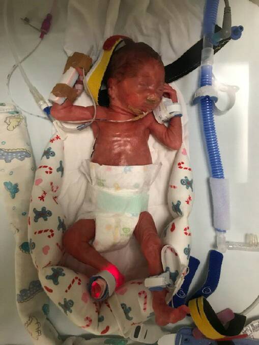 Grace was born at 25 weeks and four days, weighing only 870 grams. Photo: Supplied.