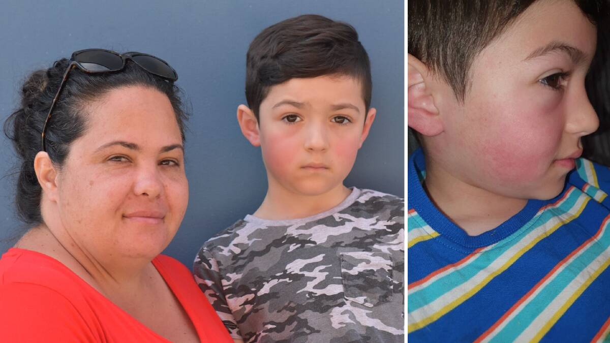 Mandurah mother issues warning after son suffers chemical burns on face from sunscreen
