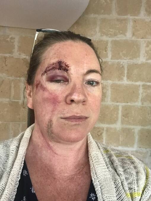 The 46 year old Perth mother attributes her battle to a fair complexion, and regular childhood exposure to the sun growing up in Capel. Photos: Supplied